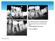 Presentations 'Endodontija bērniem - pastāvīgajiem zobiem ar nenoformētām saknēm', 12.