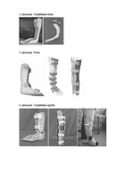 Research Papers 'Ortozēšanas iespējas apakšstilba kaulu osteomielīta izraisīto ortopēdisko traucē', 35.