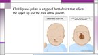 Presentations 'Cleft Lip and Palate', 4.