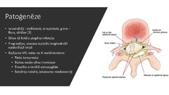 Presentations 'Spināls epidurāls abscess pēc epidurālas analgēzijas', 4.