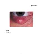 Research Papers 'Izplatītākās acu slimības', 21.