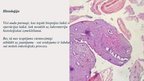 Presentations 'Melanomas biopsija, pataloģija', 2.