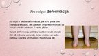 Presentations 'Kāju un pēdu deformācijas. Ārstēšana, fizioterapija', 6.