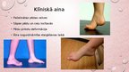 Presentations 'Kāju un pēdu deformācijas. Ārstēšana, fizioterapija', 14.