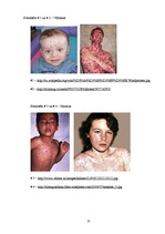 Research Papers 'Bērnu infekcijas slimības', 25.