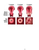 Research Papers 'Dzemdes kakla vēža citoloģiska diagnostika', 12.