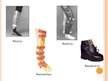 Presentations 'Ortozēšanas iespējas apakšstilba kaulu osteomielīta izraisīto ortopēdisko traucē', 10.
