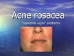 Presentations 'Acne Rosacea', 1.