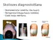 Presentations 'Korsete - palīglīdzeklis idioptiskās skoliozes ārstēšanai pusaudžu vecumā', 10.