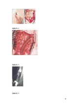 Research Papers 'Pēc A.femoralis aneirismas protezēšanas iegūtās infekcijas pacientiem', 18.