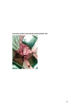 Research Papers 'Pēc A.femoralis aneirismas protezēšanas iegūtās infekcijas pacientiem', 21.