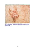 Research Papers 'Bezpigmenta melanoma', 16.