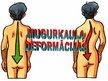 Presentations 'Mugurkaula deformācijas', 1.