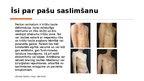 Presentations 'Pectus carinatum', 2.