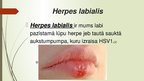 Presentations 'Herpes vīruss', 6.