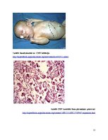 Research Papers 'Citomegalovīrusa infekcija jaundzimušajiem', 13.