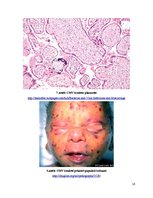 Research Papers 'Citomegalovīrusa infekcija jaundzimušajiem', 16.