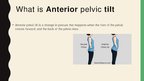 Presentations 'Anterior Pelvic Tilt', 2.