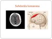 Presentations 'Centrālās nervu sistēmas traumatiski bojājumi', 16.