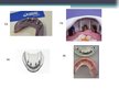 Summaries, Notes 'Izņemamās zobu protēzes balstītas, uz implantiem', 40.