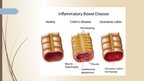 Presentations 'Crohn's Disease', 2.
