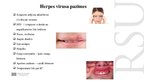 Presentations 'Kāpēc zobu higiēnistiem nekad nevajadzētu ārstēt pacientu ar aktīvu orālo herpes', 4.