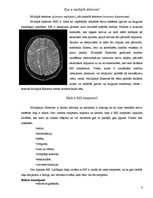 Summaries, Notes 'Multiplā skleroze', 2.