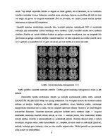 Research Papers 'Multiplā jeb izkaisītā skleroze', 6.