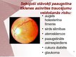 Presentations 'Cilvēka acu un redzes slimības', 4.