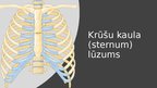 Presentations 'Iegurņa kaula lūzumi, iegurņa stabilizācijas tehnikas. Krūšu kurvja, krūšu kaula', 43.