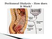 Presentations 'Peritoneal Dialysis', 4.