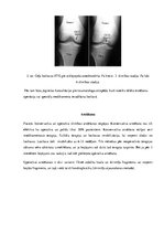 Research Papers 'Osteohondritis dissecans jeb atslāņojošais osteohondrīts', 4.