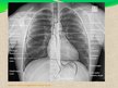 Presentations 'Pacienta aprūpe, veicot krūškurvja rentgenogrammu pie nediagnosticētas plaušu tu', 7.