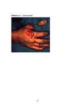 Research Papers 'Rokas - plaukstas plastiskā ķirurģija', 23.