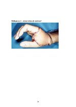 Research Papers 'Rokas - plaukstas plastiskā ķirurģija', 24.