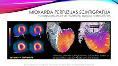 Presentations 'Stabilas koronāro artēriju slimības diagnostika', 25.