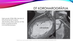 Presentations 'Stabilas koronāro artēriju slimības diagnostika', 32.