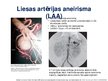 Presentations 'Viscerālo artēriju aneirismas', 2.