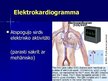 Presentations 'EKG pamati, dzīvībai bīstamie ritmi', 3.