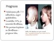 Presentations 'Pjēra Robēna sindroms', 11.