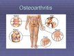 Presentations 'Osteoarthritis', 1.