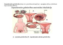 Summaries, Notes 'Ektopiskas grūtniecības anatomiska lokalizācija', 2.